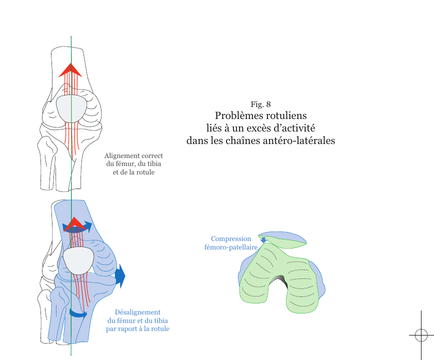 Schéma des problèmes rotuliens liés à un excès d'activité dans les chaînes antéro-latérales