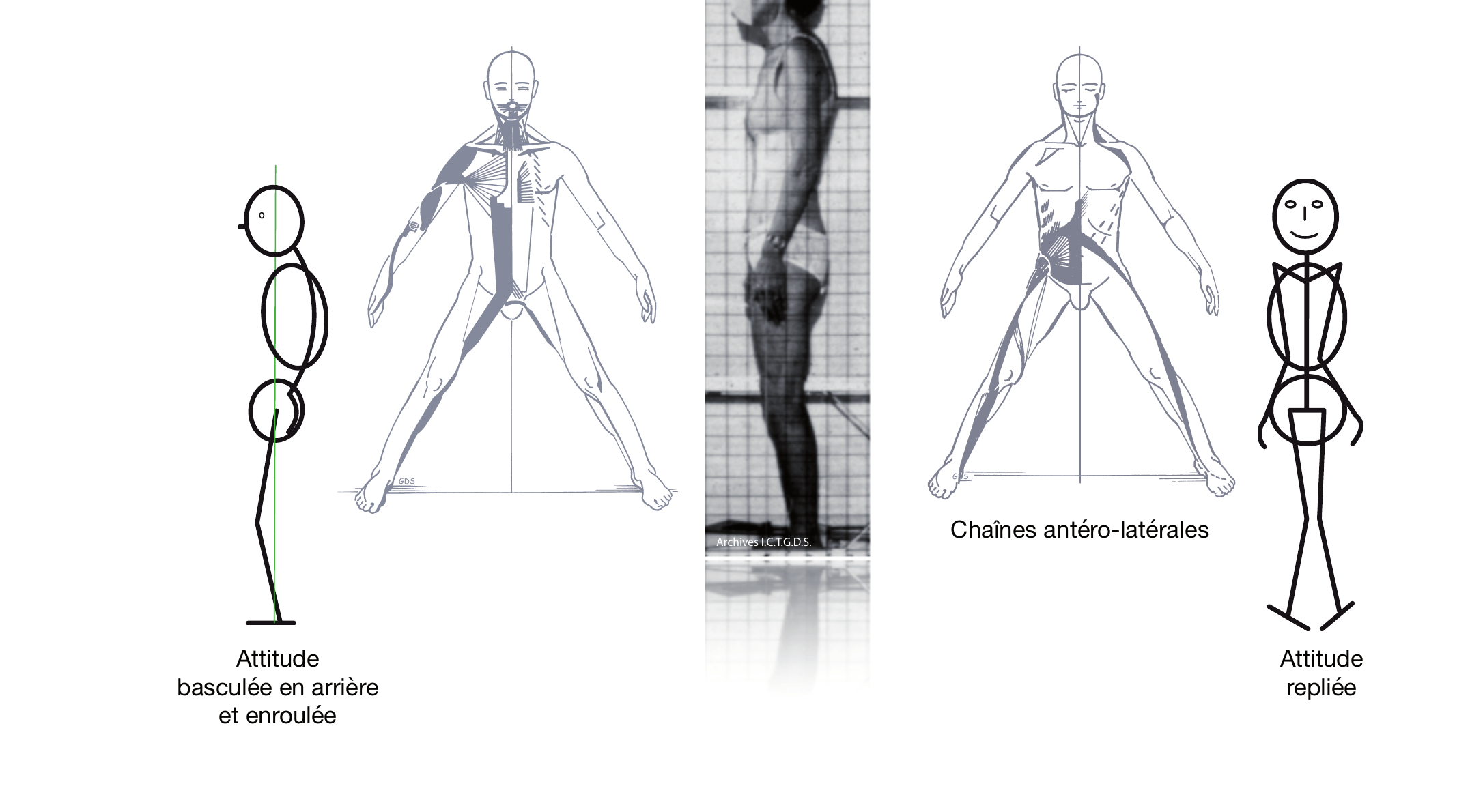 Typologie combinée AM-AL : attitude basculée en arrière et enroulée (chaînes antéro-médianes), attitude repliée (chaînes antéro-latérales)