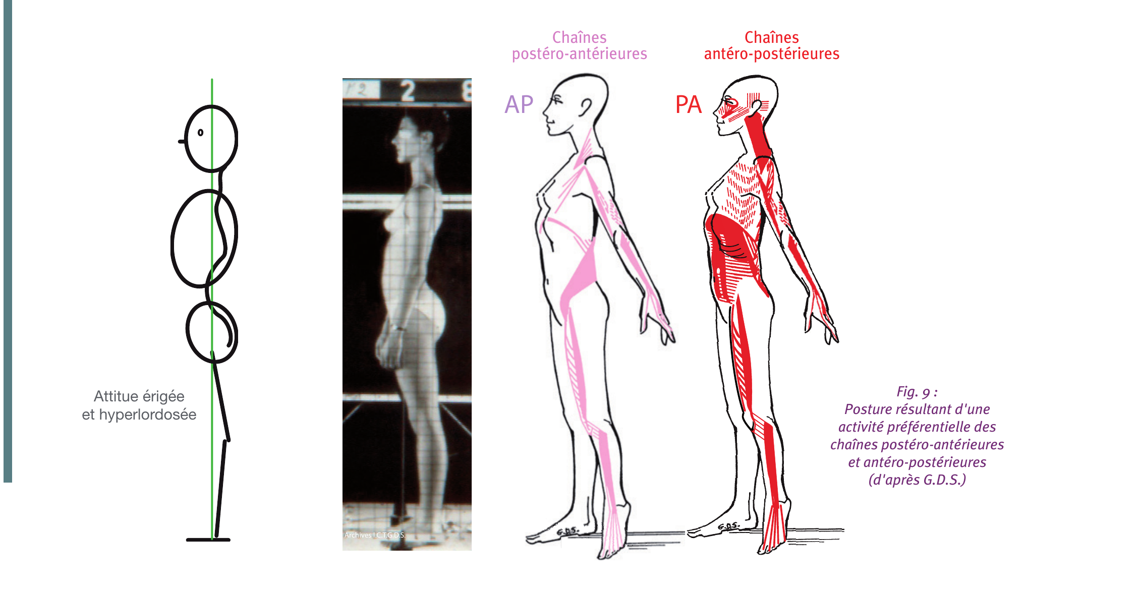 Posture résultant d'une activité préférentielle des chaînes postéro-antérieures (AP) et antéro-postérieures (PA) : attitude érigée et hyperlordosée
